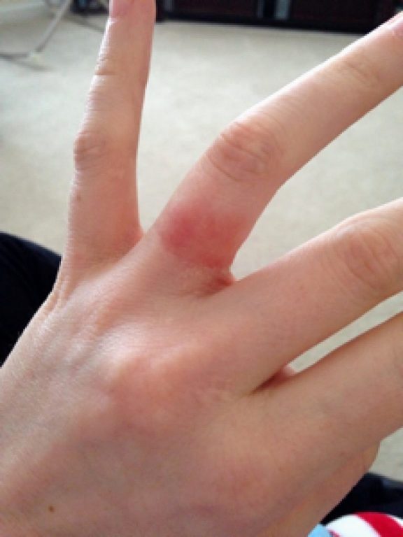 wedding ring rash